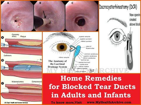 blocked tear duct repair